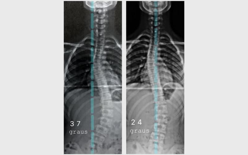 Imagem 1 sobre escoliose