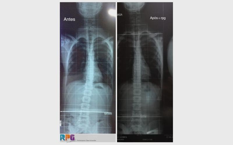 Imagem 2 sobre escoliose