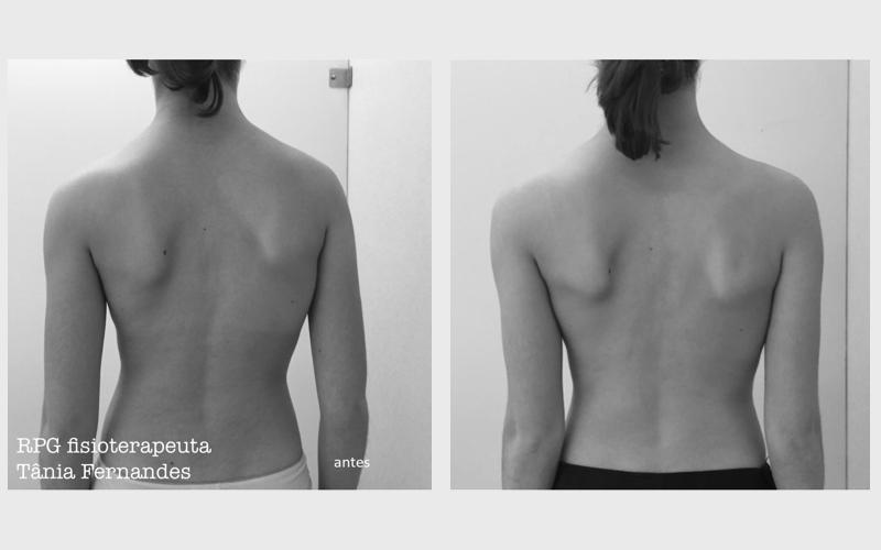 Imagem 4 sobre escoliose