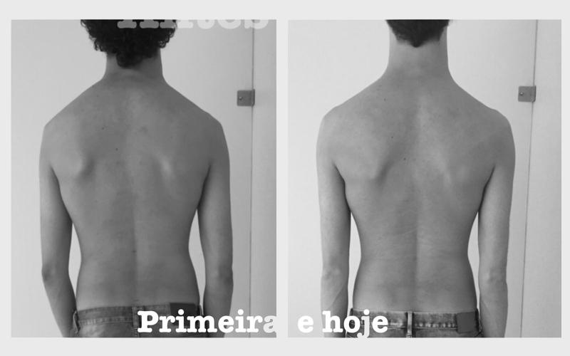 Imagem 6 sobre escoliose